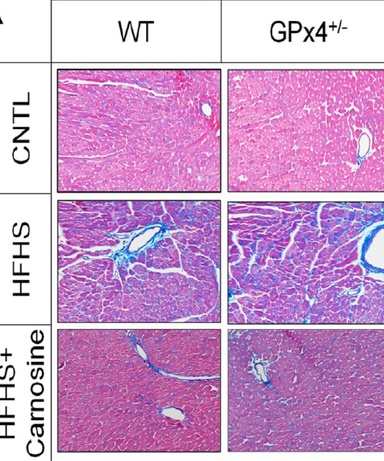 carnosine effect on cardiac fibrosis